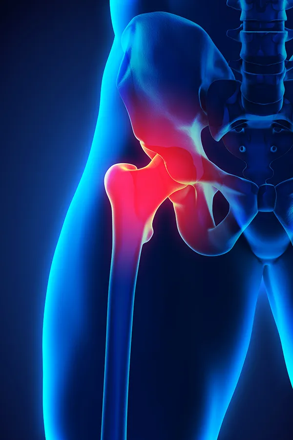 Labrum-Tears-Treatment 3D illustration of the human hip joint. Get treatment for larum tears from Lux Hormones & Health Wellness in San Diego.
